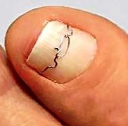  Klamra metalowa drutowa na wrastające paznokcie